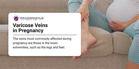 Bulging Painful Leg Veins During Pregnancy Can They Be Treated Vein Endovascular Medical Care
