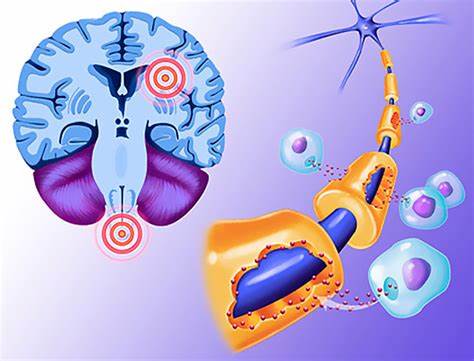 Рассеянный склероз диета Рассеянный склероз: питание и образ жизни Рассеянный склероз: питание и образ жизни Рассеянный склероз диета