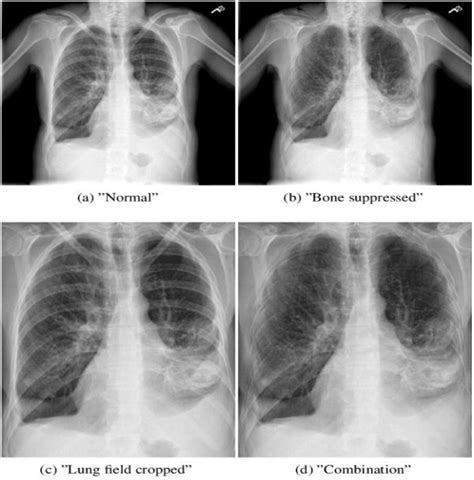 Intelligent Pneumonia Identification From Chest X Rays A Systematic