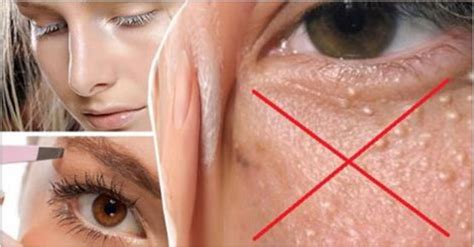 Cómo Eliminar El Milium De La Cara Alrededor De Los Ojos