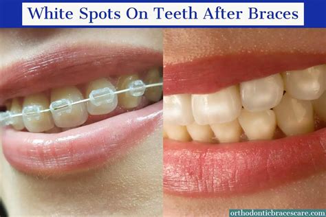 Teeth Treat How To Get Rid Of White Stains On Teeth After Braces