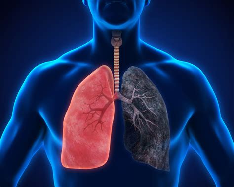 Enfisema Pulmonar é Grave