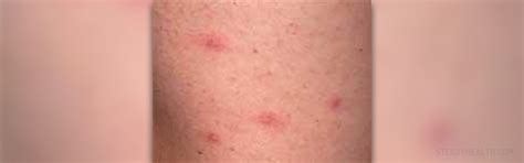 Itchy Rash On Chest General Center