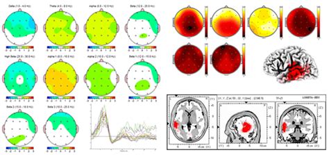 Quantitative Eeg Qeeg The Well Mind Center