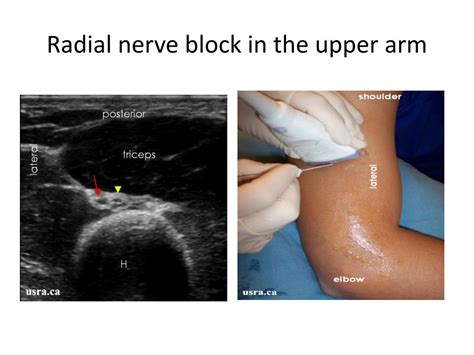 Ppt Regional Anaesthesia An Introduction To Peripheral Nerve Blocks