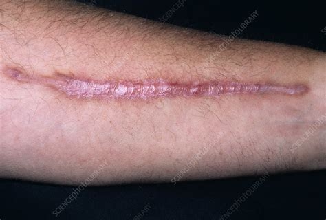 Keloid Scar Stock Image M3320094 Science Photo Library