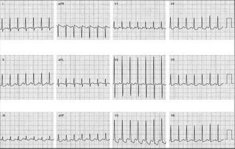 Atrial Tachycardia Diagnosis The Cardiology Advisor