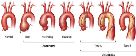 Life Expectancy After Thoracic Aortic Aneurysm Surgery Good Life