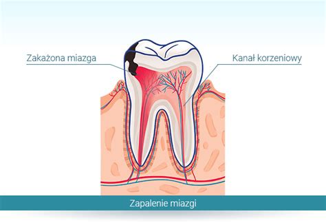 Zapalenie Miazgi Objawy I Leczenie Strefa Pacjenta Dexak