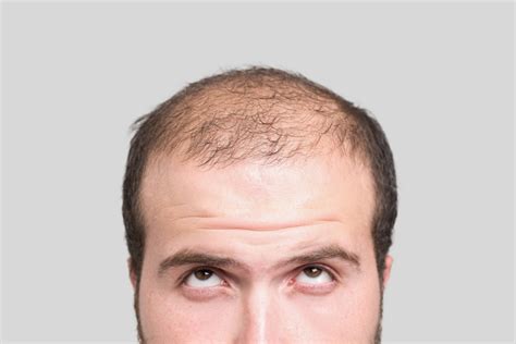 6 Common Hair Loss Causes In Men Man Of Many