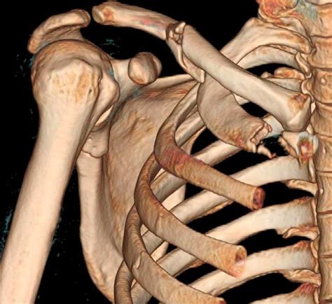 Fracturas de costillas, síntomas y tratamiento