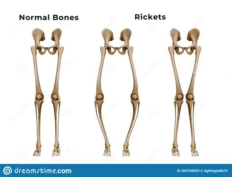 Rickets Is A Metabolic Disease Characterized By Deformities Of The