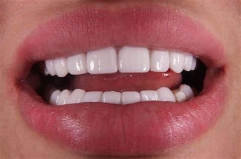 Expert Tips To Avoid Bad Veneers The Teeth Blog