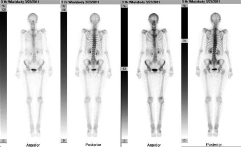 Bone Scans Shim Spine