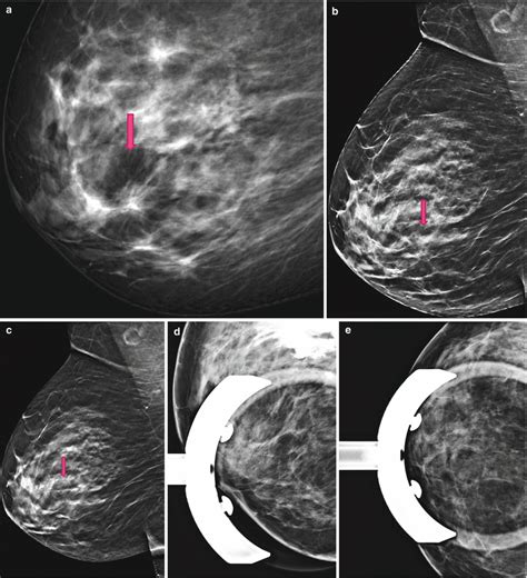 Synthetic 2d Mammography With 3d Tomosynthesis As Screening Tool Early