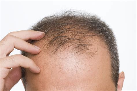 Fue Frontal Hair Transplant Chicago Il