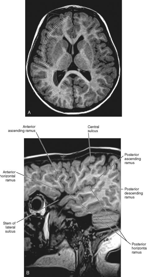 Surface Anatomy Of The Brain Radiology Key