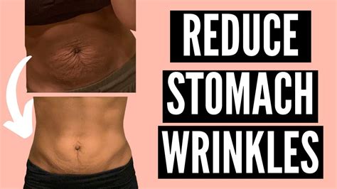 how to get rid of stomach wrinkles postpartum naturally not dermarolling tighten loose skin
