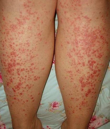 How To Avoid Para Psoriasis Dorothee Padraig South West Skin Health Care