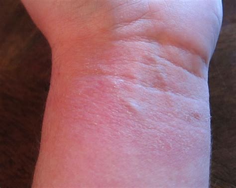 Photos Of Poison Ivy Rashes Poison Ivy Cures Help And Information