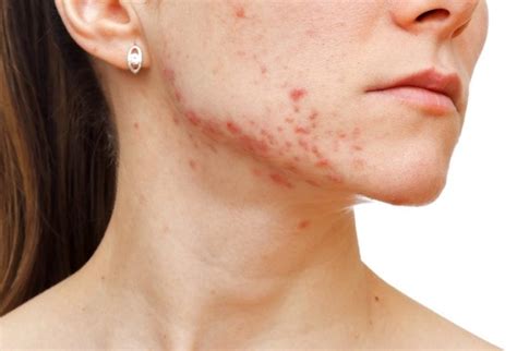 Dealing With Adult Acne The Banwell Clinic