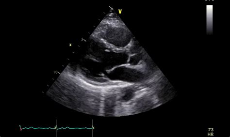 Echocardiography Echocardiogram Cardiac Sonography Va Vrogue Co