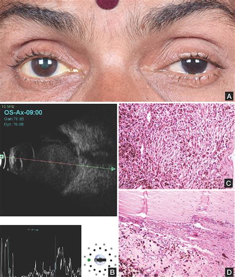 Choroidal Melanoma With Secondary Glaucoma A Clinical Photograph Of A