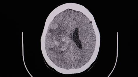 🔥 Video Of Ct Brain A Patient With Hemorrhage And Hematoma At Right