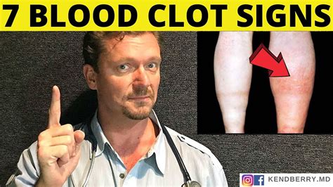 7 Warning Signs Of A Blood Clot Symptoms 2024 Youtube