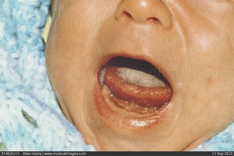 Stock Image Severe Oral Thrush Candidiasis A Fungal Infection Caused