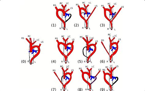 Classification Scheme For Aortic Arch Anomalies Leading To A Vascular