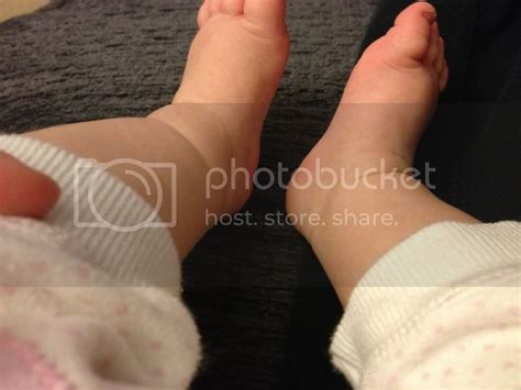 Baby Has Lump On Her Ankle Babycenter