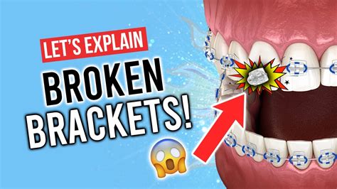 Do Broken Brackets Delay Braces Treatment Youtube