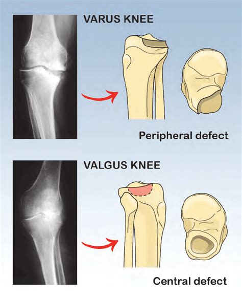Usually Varus Knee Appears With Bone Defect In Posteromedial Site Of
