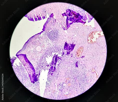 Inflammatory Breast Lump Chronic Nonspecific Mastitis With Fibrocystic