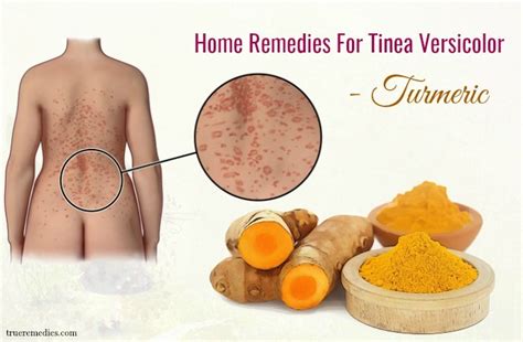 35 Home Remedies For Tinea Versicolor On Back Treatment