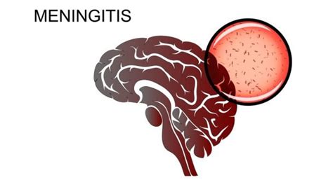 Meningitis Causes Symptoms Risk Factors Prevention And Treatment