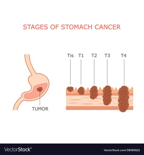 Stomach Cancer Stages Royalty Free Vector Image