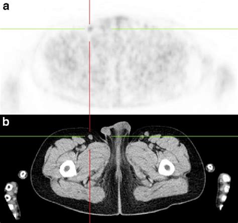 Fdg Petct Of A Patient Being Staged For Hd The Attenuation Corrected