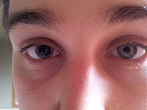 My Eyes Today Had Different Sized Pupils Rpics
