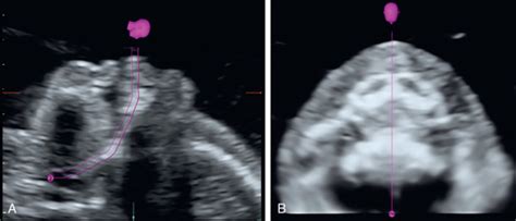 Three Dimensional Ultrasound Techniques And Clinical Applications