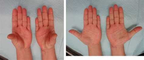 Carpal Tunnel Syndrome With Thenar Muscle Atrophy Camitz Procedure