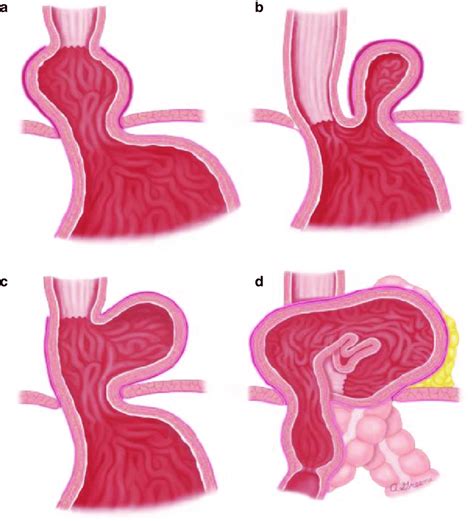 1 Types Of Hiatal Hernias A Type I Sliding Hernia B Download