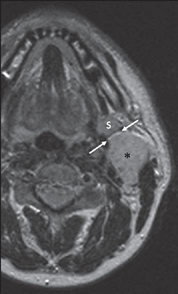 Cross Sectional Imaging Of Parotid Gland Nodules A Brief Practical