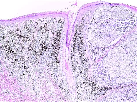 A Malignant Melanoma Arising From Medium Sized Congenital Melanocytic