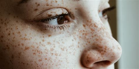 Freckles Explained How To Check Your Spots For Cancer Or Other