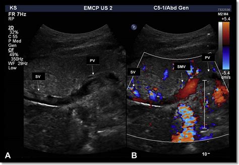 Endovascular Stenting Of Portal Vein For Graft Rescue After A Pancreas