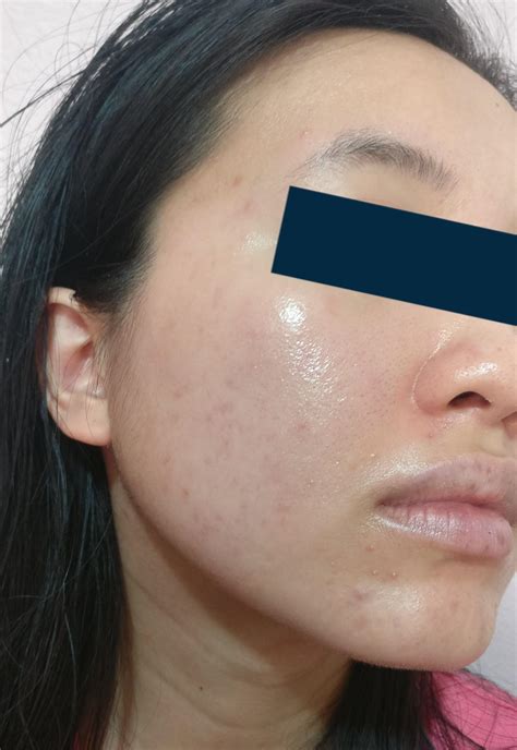 Fungal Acne And Acne Scars Help With Fixing Skincare Routine Fungalacne