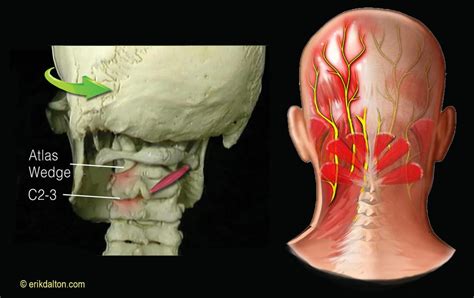Occipital Neuralgia Headaches Erik Dalton Blog