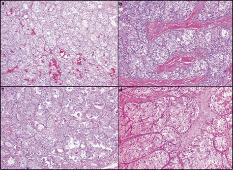 Histologic Features Of Alveolar Soft Part Sarcoma And Xp112 Renal Cell